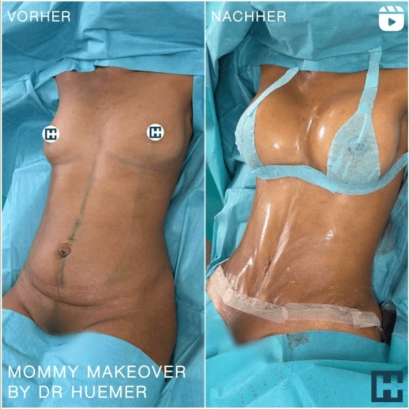 Vorher nachher OP Bild eines Mommy Makeover durchgeführt von Dr. Huemer aus Linz