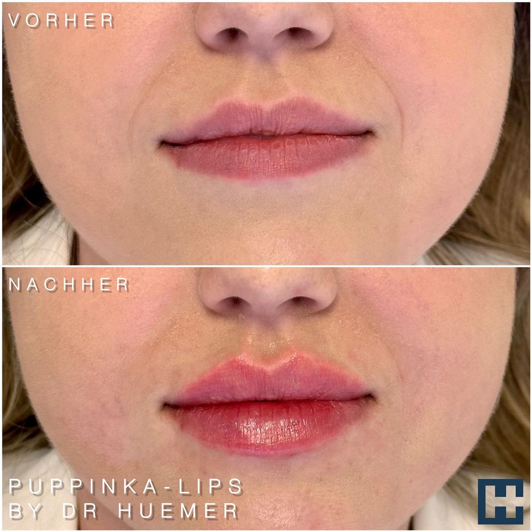 Vorher Nachher Bild einer Lippenkorrektur "Puppinka-Lips" durchgeführt von Dr. Huemer, Linz